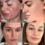 The Medicube Red Acne Succinic Acid Peel 40g - Image 3