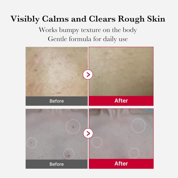 Medicube Red Acne Body Peeling Shot 110g - Image 4